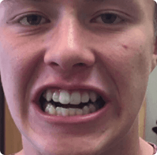 Men showing his open bite teeth | Orthofx