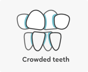 Crowded Teeth