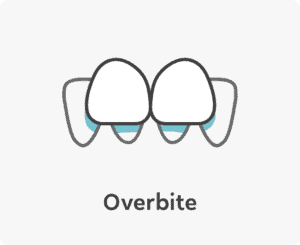 overbite