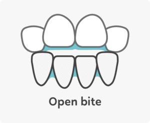 Open bite teeth | OrthoFx