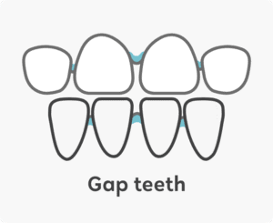 Gap teeth Image | OrthoFx